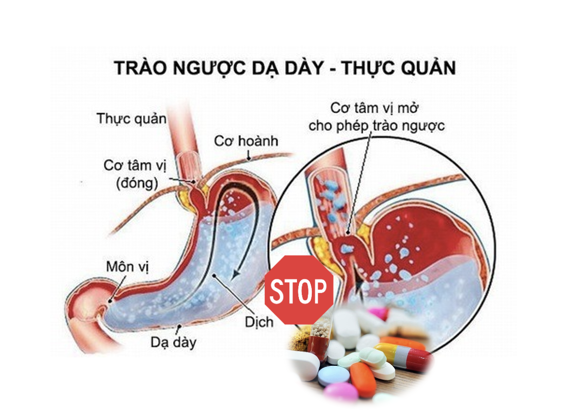 VÌ SAO NGƯỜI BỆNH TRÀO NGƯỢC DẠ DÀY - THỰC QUẢN KHÔNG NÊN LẠM DỤNG THUỐC GIẢM TIẾT ACID?